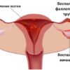 nedorazvityj-endometrij-odna-iz-prichin-besplodiya